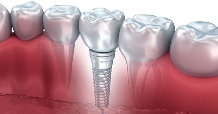 種植牙