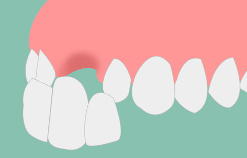 梅州二氧化鋯烤瓷牙多少錢一顆