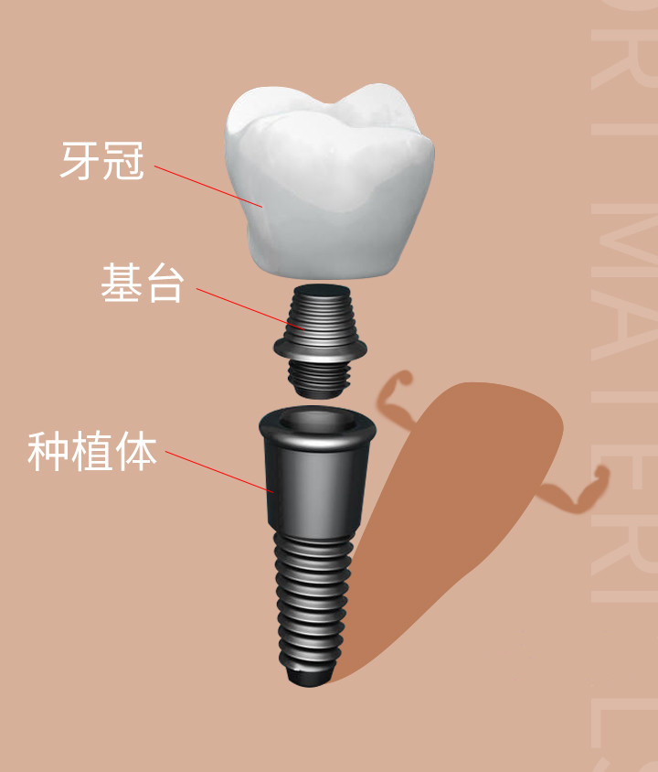 種植牙結(jié)構(gòu)圖 種植牙結(jié)構(gòu)圖