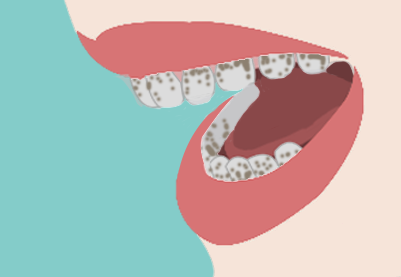 茶漬黑牙 茶漬黑牙